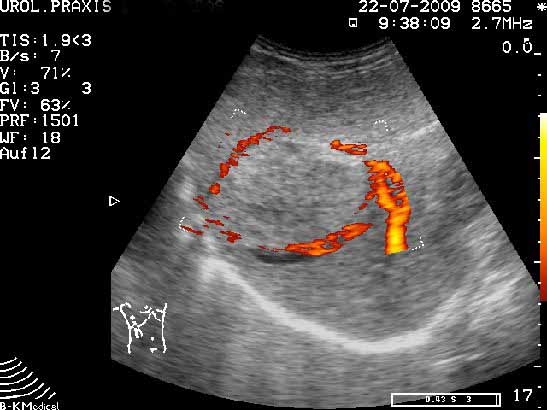 Lebertumor